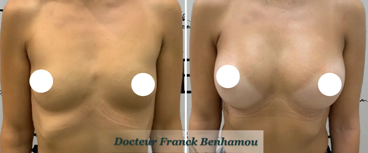 Photo avant après augmentation mammaire