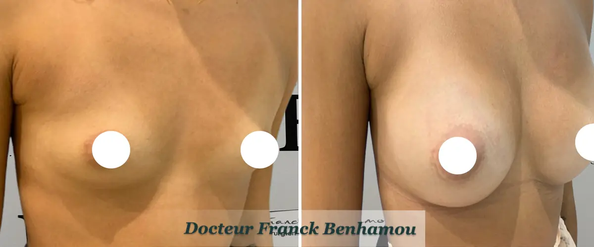 Photo avant après augmentation mammaire