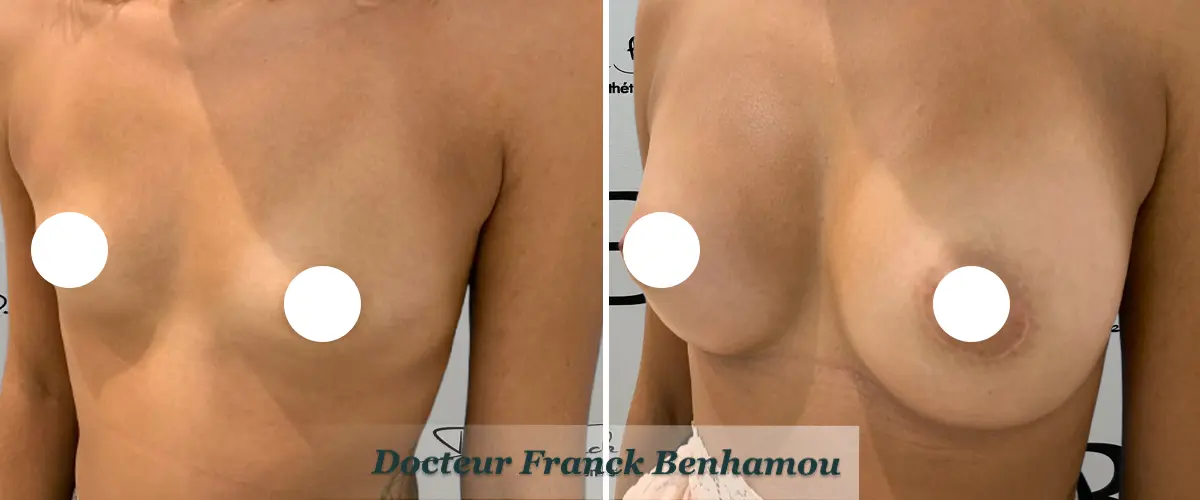 Photo avant après augmentation mammaire