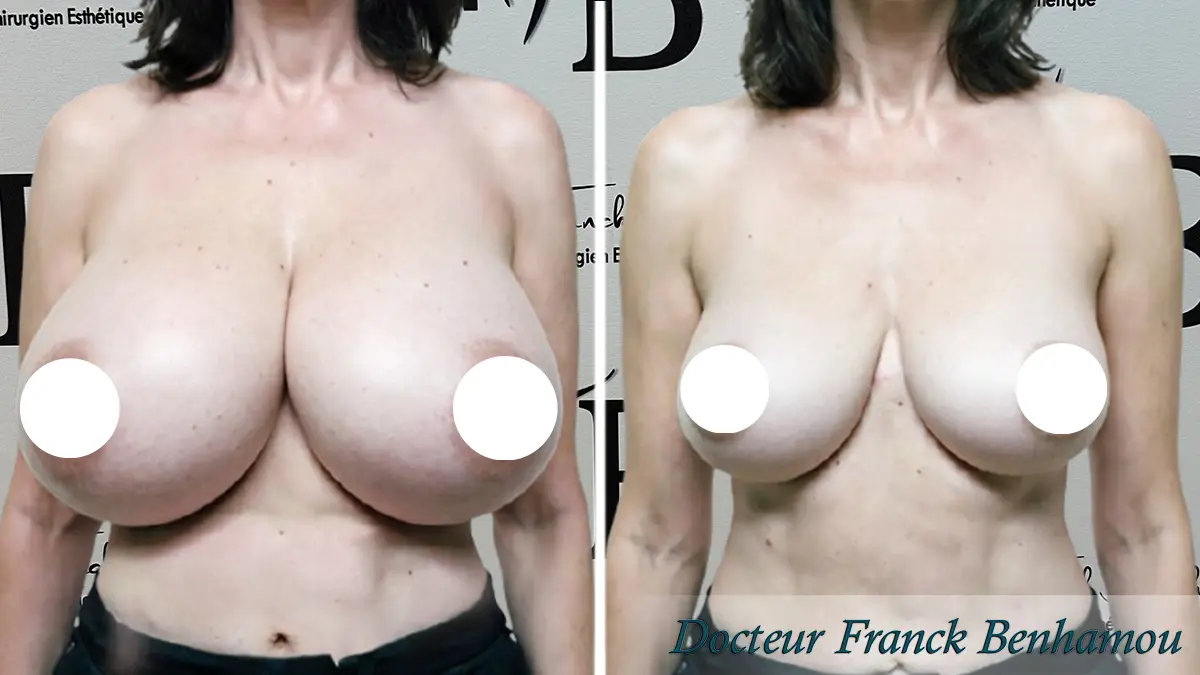 Photo avant après réduction mammaire