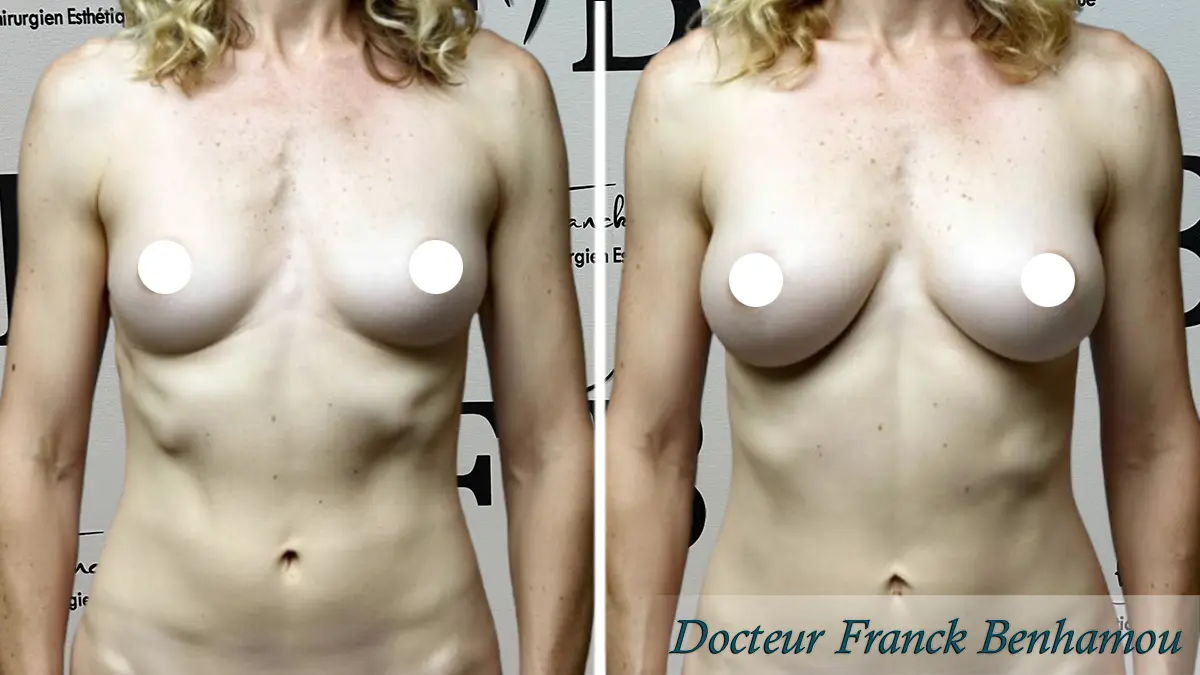 Photo avant/après lipofilling des seins