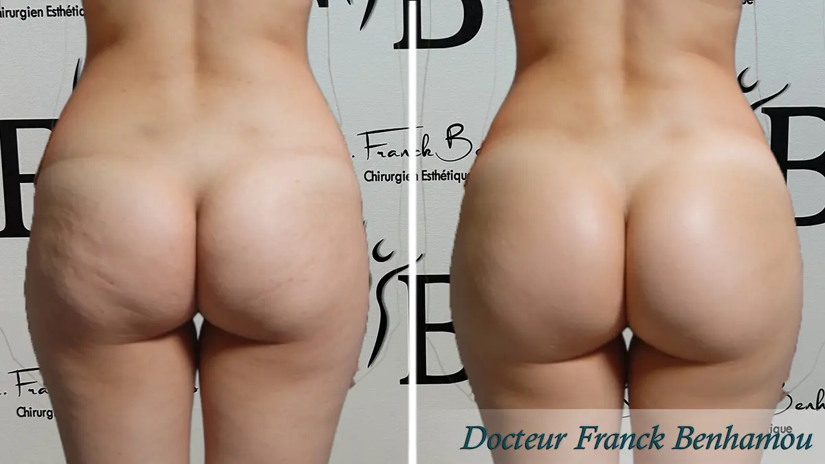 bbl lipofilling des fesses photo avant après