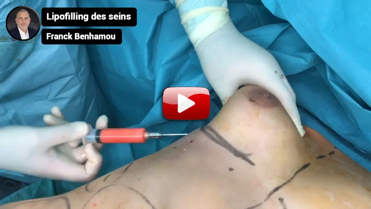 Lipofilling des seins.