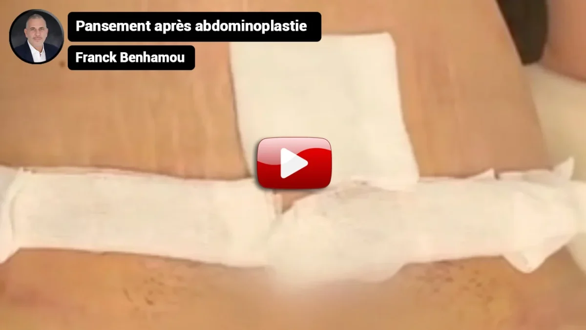 Pansement après abdominoplastie.