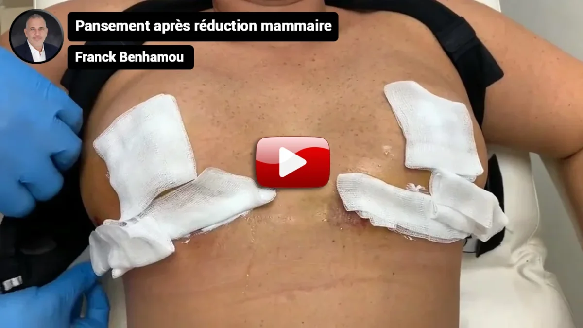 Pansement après réduction mammaire.