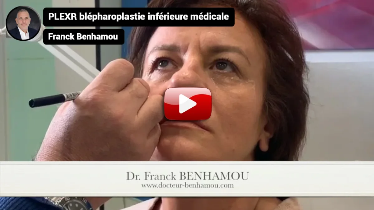PLEXR blépharoplastie inférieure médicale.