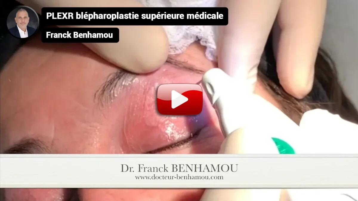 PLEXR blépharoplastie supérieure médicale.