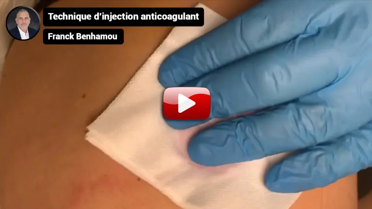 Technique d’injection anticoagulant.